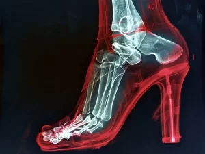 Ankle Sprain Recovery Guide