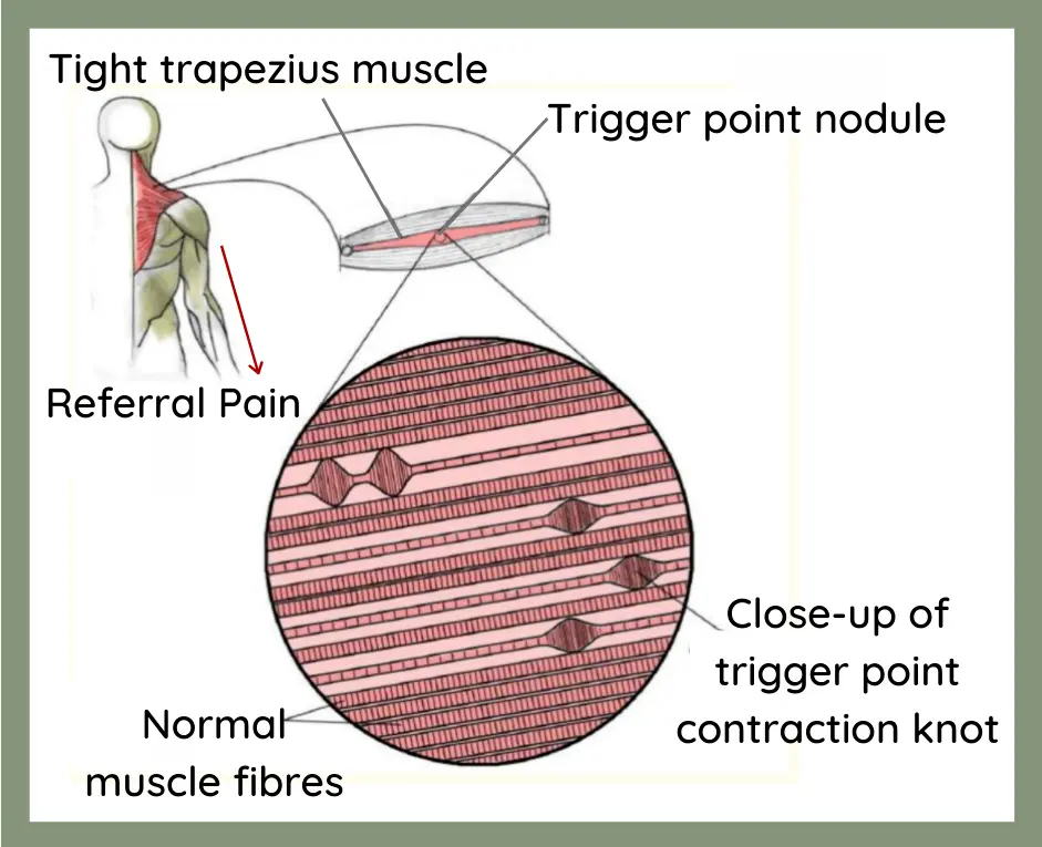 How It Works dry needling