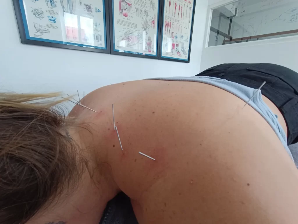 Physiotherapist performing dry needling for back pain relief in Phnom Penh.