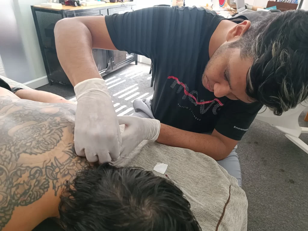 Close-up of a dry needling session targeting a tight muscle at Movement Cambodia.