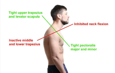 "Upper cross syndrome"
